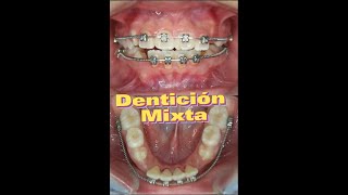 Dentición Mixta 🦷🫠👶 [upl. by Gettings]