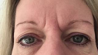 Hooded Eye Lids  Plasma Pro  Plasma Blast  Fibroblast [upl. by Essy]