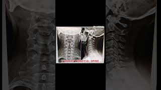 XRAY OF CERVICAL SPINE RADIOLOGY [upl. by Ylrebmek]