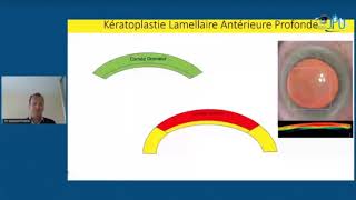 Kératocône en cas clinique congrès JPO 2021 [upl. by Clevie]