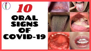 ORAL SIGNS OF CORONAVIRUS COVID 19  CORONAVIRUS SYMPTOMS [upl. by Mihalco614]