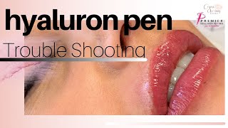 Hyaluron Pen troubleshooting retention and lumps [upl. by Ayaros]