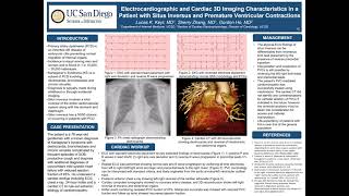 Electrocardiographic and Cardiac 3D Imaging Characteristics in Patient with Situs Inversus and PVCs [upl. by Elwaine44]