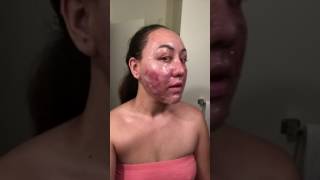 Acne Scars Journey Day 3 co2 fractional laser acne scars [upl. by Ebony]