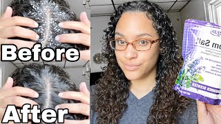 EPSOM SALT SCALP SCRUB Before  After [upl. by Vogel965]