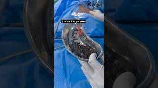 Kidney stone treatment  How kidney stone is removed RIRS PCNL shorts [upl. by Falconer452]