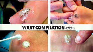 WART BURNING COMPILATION Part 14  Dr Paul [upl. by Hallam]