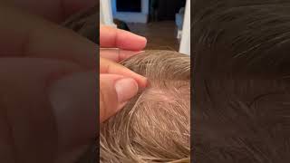 Lice picking l lice removal l small business explore hair lice hairvideo [upl. by Muslim894]