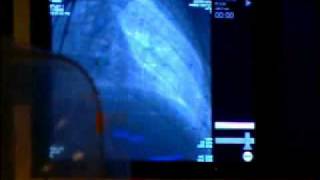 Catheterization and Stent procedure at Mercys Oklahoma Heart Hospital [upl. by Neit76]