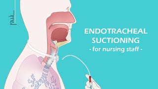 Endotracheal suctioning ETS for nursing staff  Animation  Fahl MedizintechnikVertrieb GmbH [upl. by Ecirtnas]