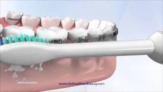 How to use your Philips Sonicare Toothbrush perfect for braces too [upl. by Allerus]