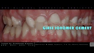 Glass Ionomer Cement [upl. by Armando607]