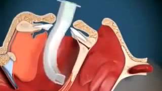 Técnica de Colocação da Cânula Orofaríngea [upl. by Thorbert]