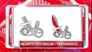 NEURITIS VESTIBULAR TRATAMIENTO [upl. by Dermott]