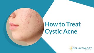 How to Treat Cystic Acne [upl. by Halvaard339]