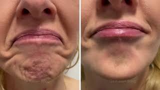 Botox Injections for Dimpled Uneven Puckered Orange Peel Chin [upl. by Diana280]