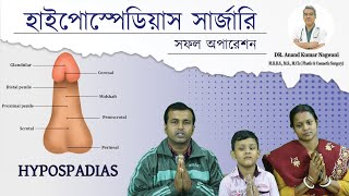 Hypospadias  প্রস্রাব সঠিক জায়গায় না খোলার সমস্যা  Hypospadias Repair in India  Dr Nagwani [upl. by Coke]