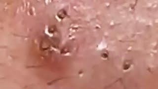 Extraction profonde des points noirs Acné kystique et popping 4 [upl. by Ettedanreb564]