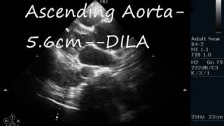 DISSECTION OF AORTA  ECHOCARDIOGRAPHY SERIES BY DR ANKUR K CHAUDHARI [upl. by Isayg]