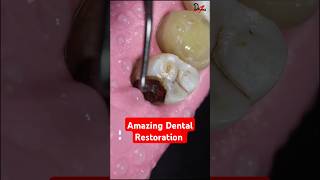 Dental Restoration of a Massive Decay asmr rct dentalcrowns [upl. by Batsheva388]