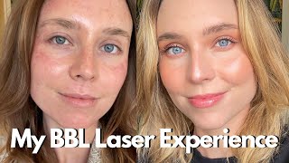 My BBL Laser Experience What You Need To Know BroadBand Light Photofacial [upl. by Aihseken]