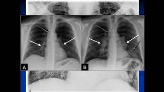 Seminario de síndromes pulmonares Radiología Pulmonar  Dr Alejandro Dangelo [upl. by Derron]