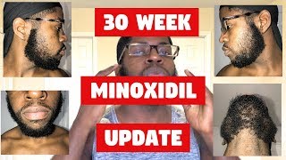 Growing a Beard With Minoxidil A Black Mans Experience Week 30 Steady Progress [upl. by Thursby]