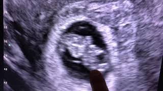 Sonogram 9 weeks pregnant [upl. by Sherill]