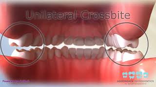 Posterior Crossbite [upl. by Nnylyt]