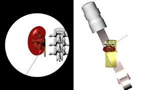 ESUT educational video on fluoroscopic guided puncture in PCNL All techniques step by step [upl. by Anchie]