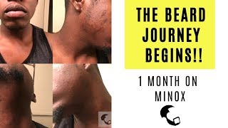 Growing a Beard With Minoxidil A Black Mans Experience 1 Month In [upl. by Dyob]