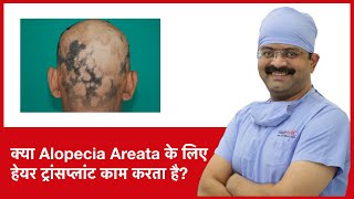 Does Hair Transplant Work For Alopecia Areata  HairMD Pune  In HINDI [upl. by Allemap]