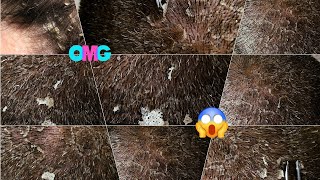 Extreme Dandruff Scratching And Removal BIG FLAKES [upl. by Skipper]