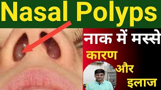 Nasal Polyps Home Remedy How I Cure Them Naturallyनाक में मांस बढ़ने का इलाज [upl. by Sine]