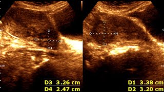 Three cases of Leiomyoma Uterus  Abnormal Uterine Bleeding  sonographic prediction [upl. by Epillihp]