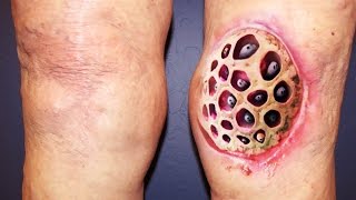 Top 100 Trypophobia Disease Photos Ever NSFE [upl. by Elleneg]