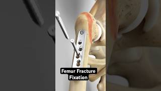 Femur Fracture Fixation Dynamic Hip Screw Method [upl. by Erleena]