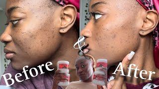 Trying Aztec Clay for 30 Days Acne Results Revealed [upl. by Ajin]