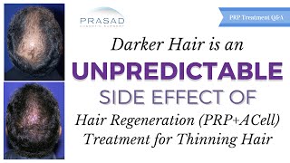 Darker Hair is a Side Effect of PRPACell Hair Loss Treatment but an Unpredictable Side Effect [upl. by Nosemaj]