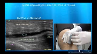 Ultrasound Guided AspirationInjection of a Morel Lavallee Lesion of the Knee [upl. by Castillo550]