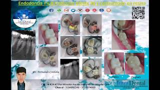 Endodoncia multirradicular diente 46 [upl. by Babbette727]