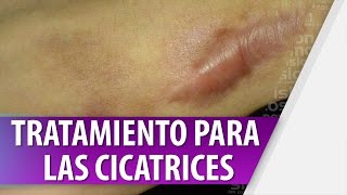 Tratamientos para las Cicatrices [upl. by Stirling]