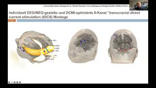 Bioelektromagnetismus Anwendung in d prächirurgischen EpilepsieDiagnose C Wolters Uni Münster [upl. by Hurst]