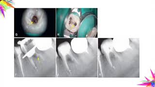 Managing iatrogenic endodontic events Dr Dania Zarzour [upl. by Kirst]