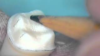 Crown preparation tooth number 30 part 3 [upl. by Nonac353]