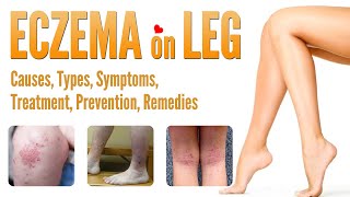 Eczema on Legs Causes Pictures Types Symptoms Treatment Prevention and Natural Home Remedies [upl. by Nnarual]