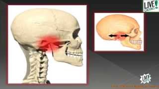 ¿Qué es el síndrome de disfunción temporomandibular ATM [upl. by Ueihttam]