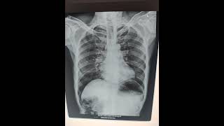 Peritonitis  pneumoperitoneum  chest x ray srivarihospital [upl. by Thurber]