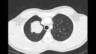 Right Upper Lobe Lung Cancer on X ray and CT [upl. by Kielty]