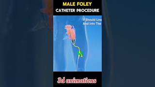 Male Foley Catheter procedure short viral malefoley medical [upl. by Alicia]